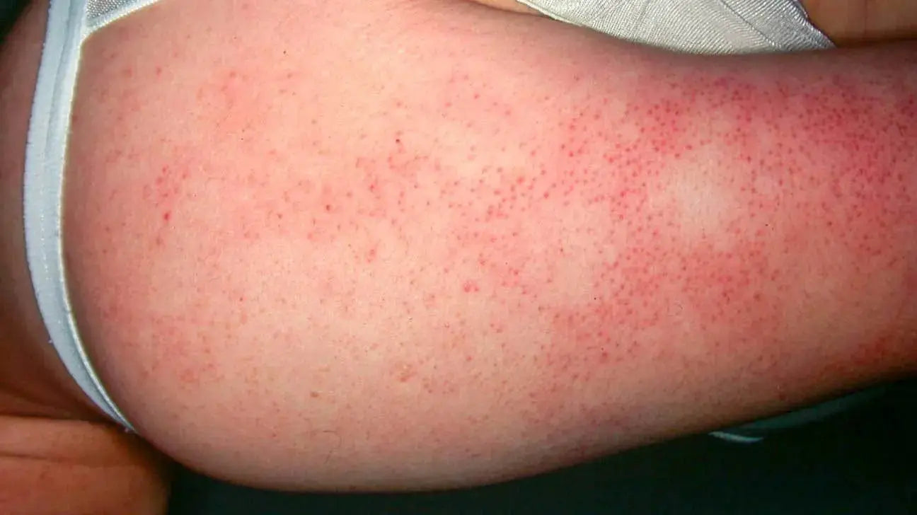 Keratosis Pilaris on the arm