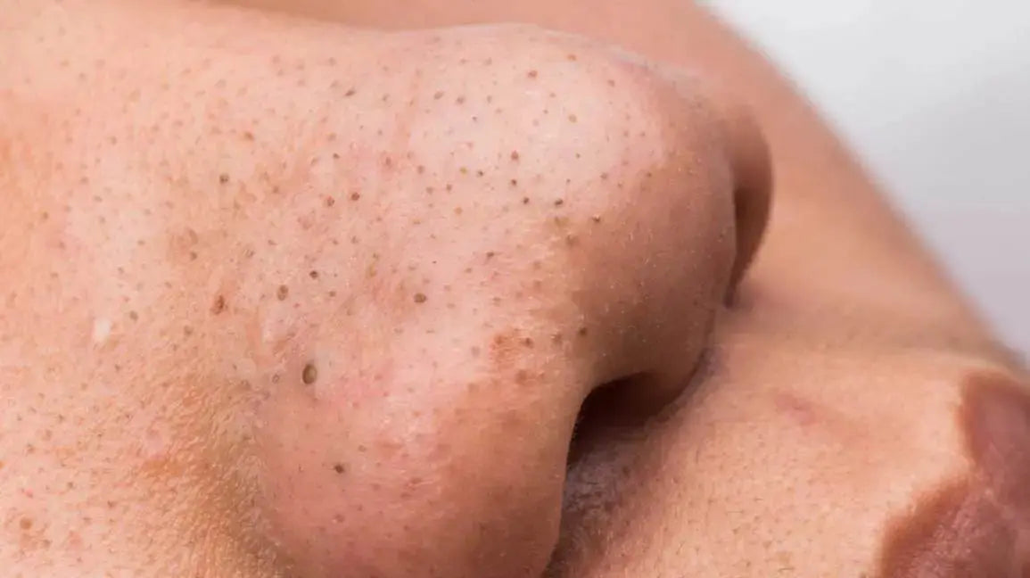 5 Tips For Getting Rid of Blackheads