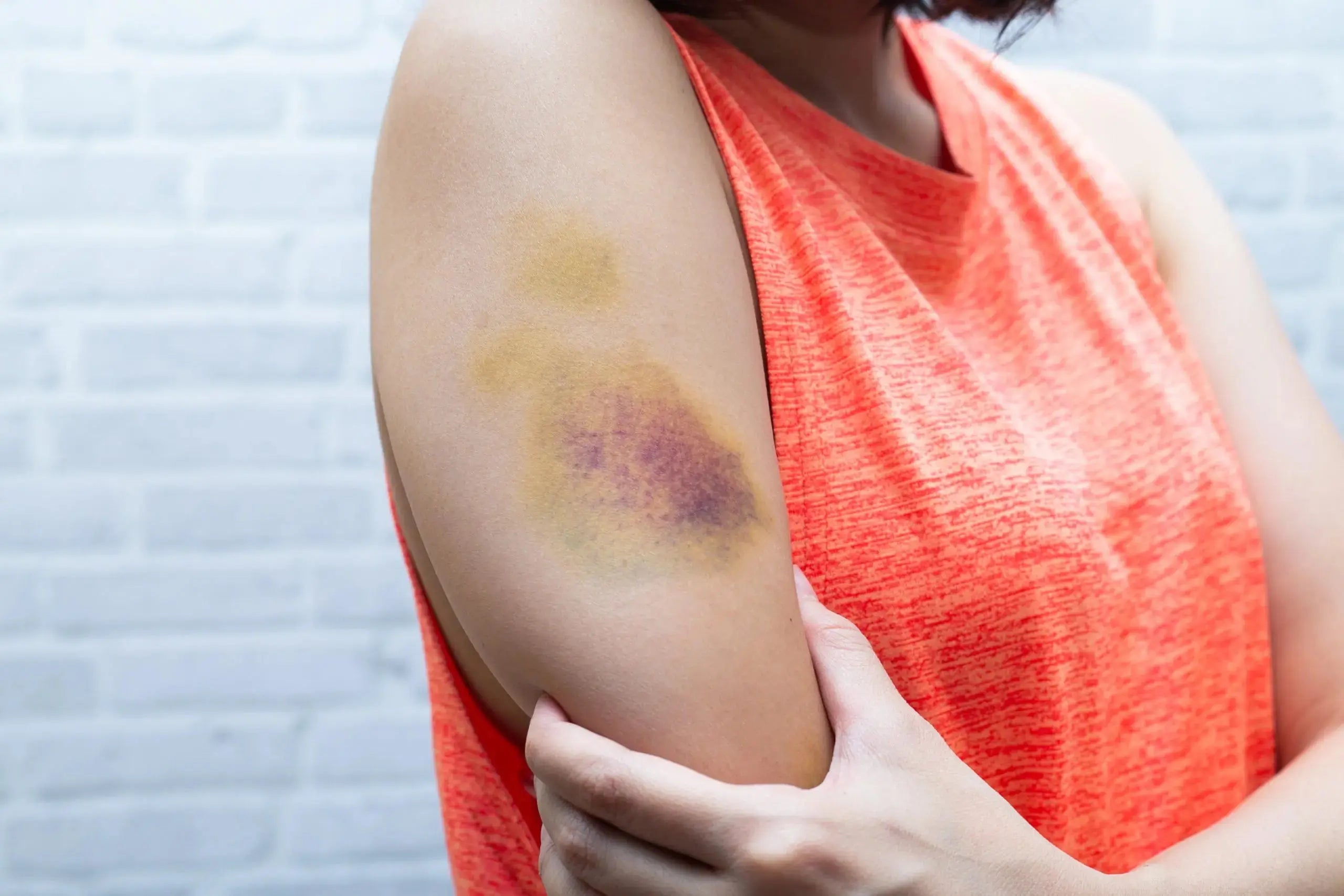 4 Effective Ways You Can Heal Bruised and Discolored Skin Faster