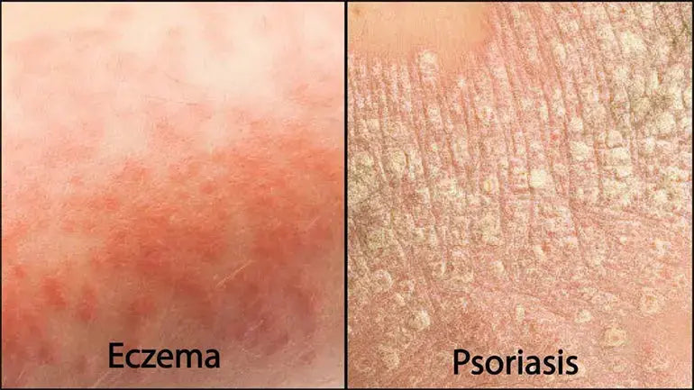 Yu-Be Skincare Tips - Eczema Vs. Psoriasis: What's the Difference?