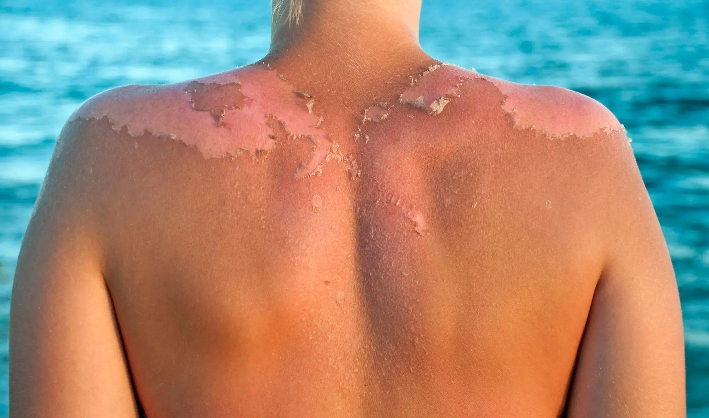 Yu-Be Skincare Tips: How to Naturally Repair Sun-Damaged Skin At Home