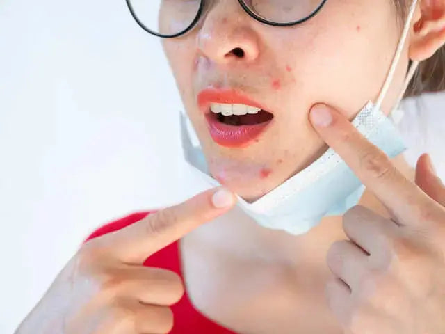 Six easy tips on how to reduce mask rashes or maskne