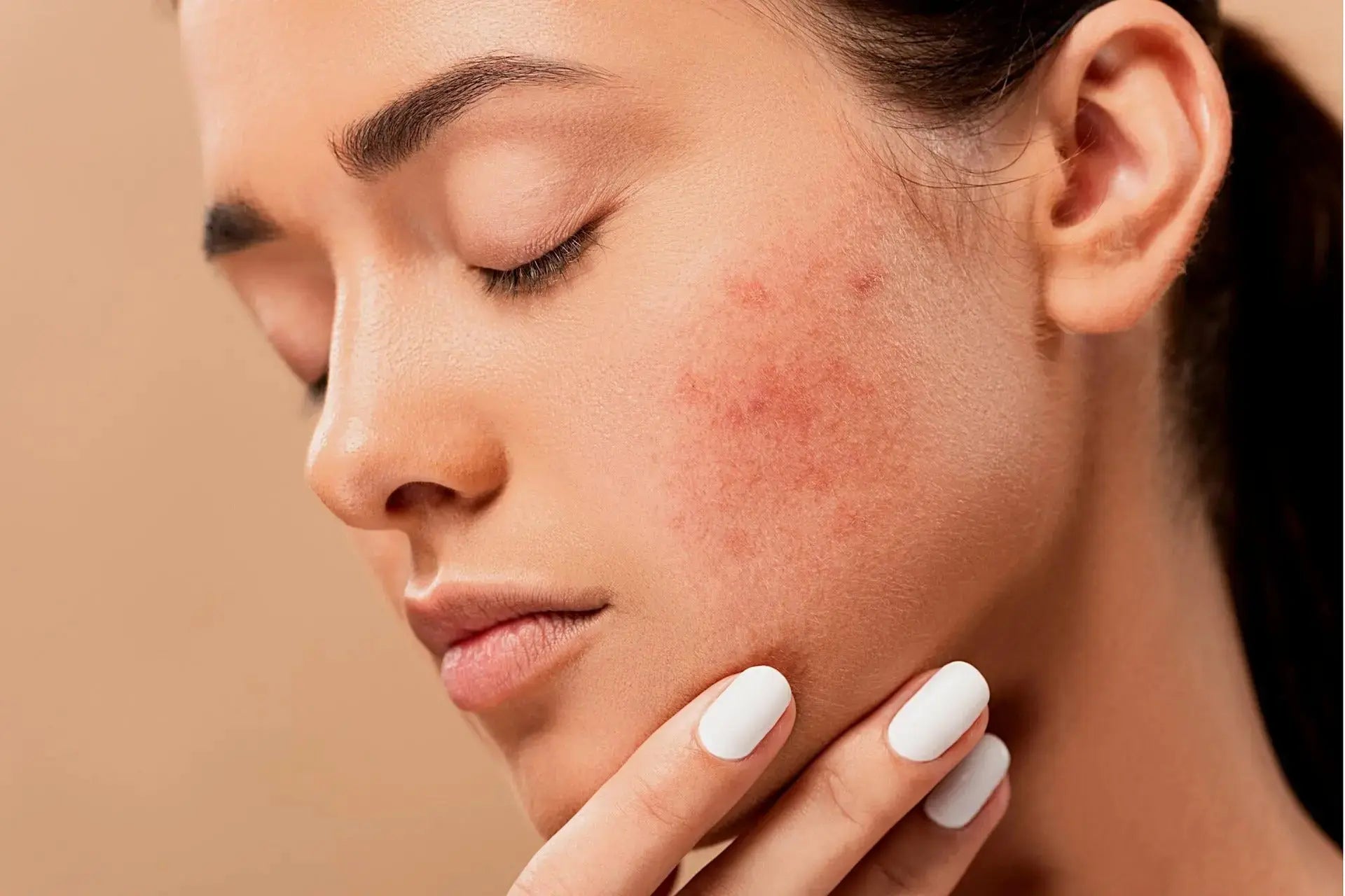 How to get rid of acne scars COMPLETELY!