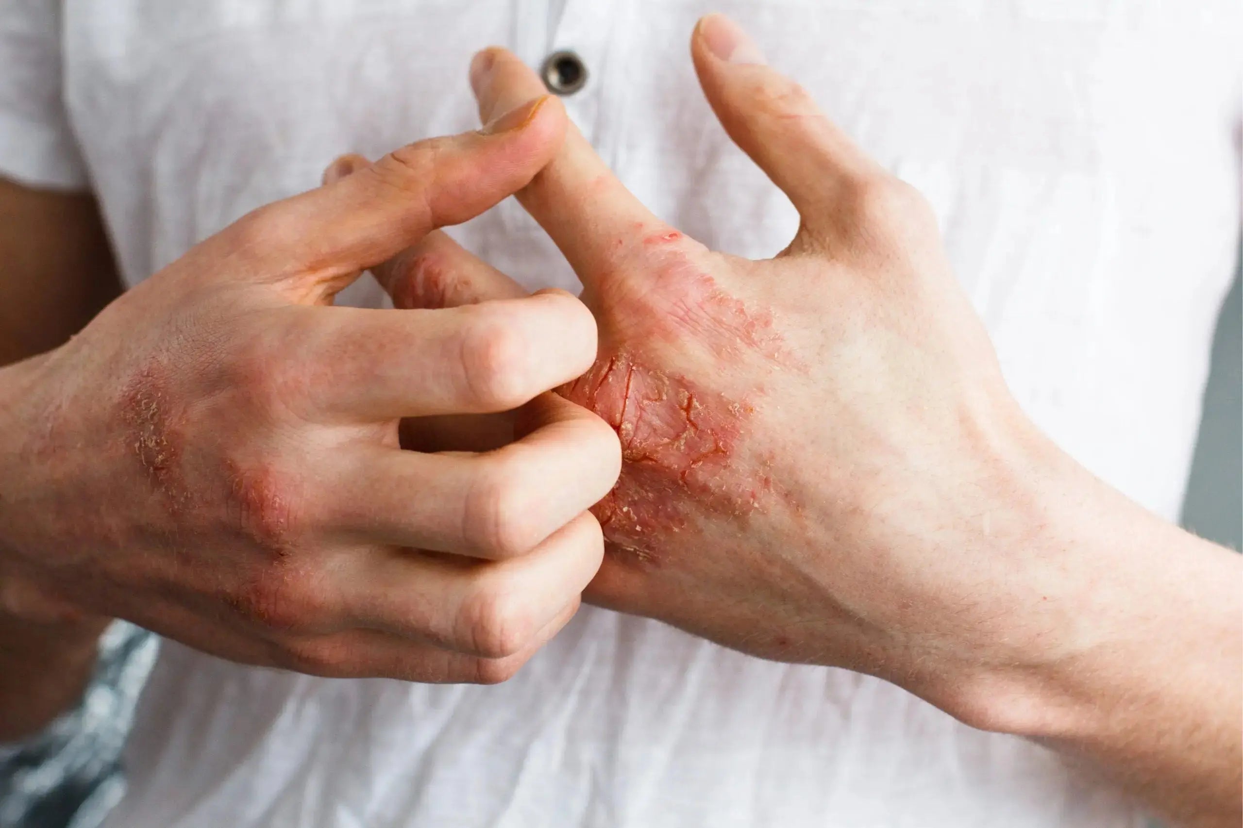 Two Essential Methods for Getting Rid of Eczema (Atopic Dermatitis)