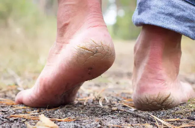 6 Simple Ways to Get Rid of Your Dry, Cracking Heels