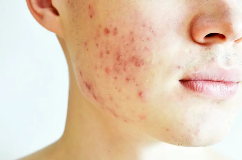 Yu-Be Skincare Blog: The Top 5 Types of Acne and How to Get Rid of Acne Once and for All