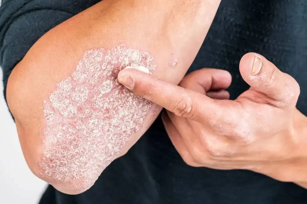Yu-Be Skincare Blog: 10 Ways to Naturally Overcome Psoriasis Symptoms