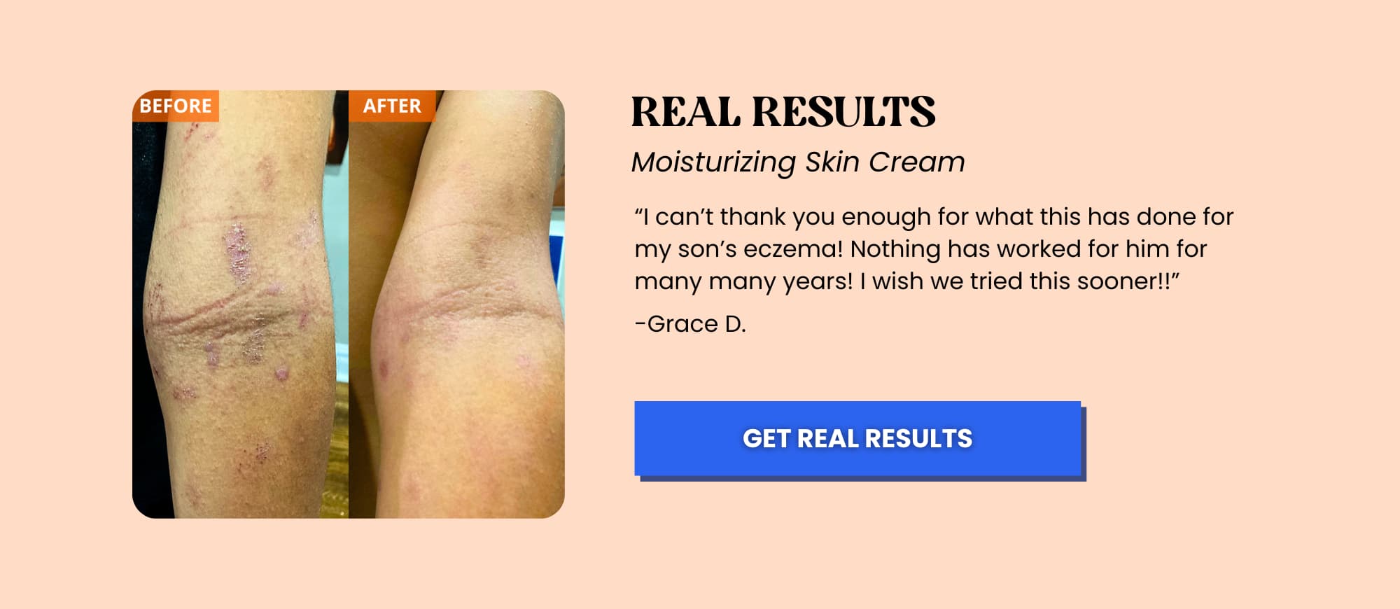 yu-be moisturizing skin cream for eczema and psoriasis