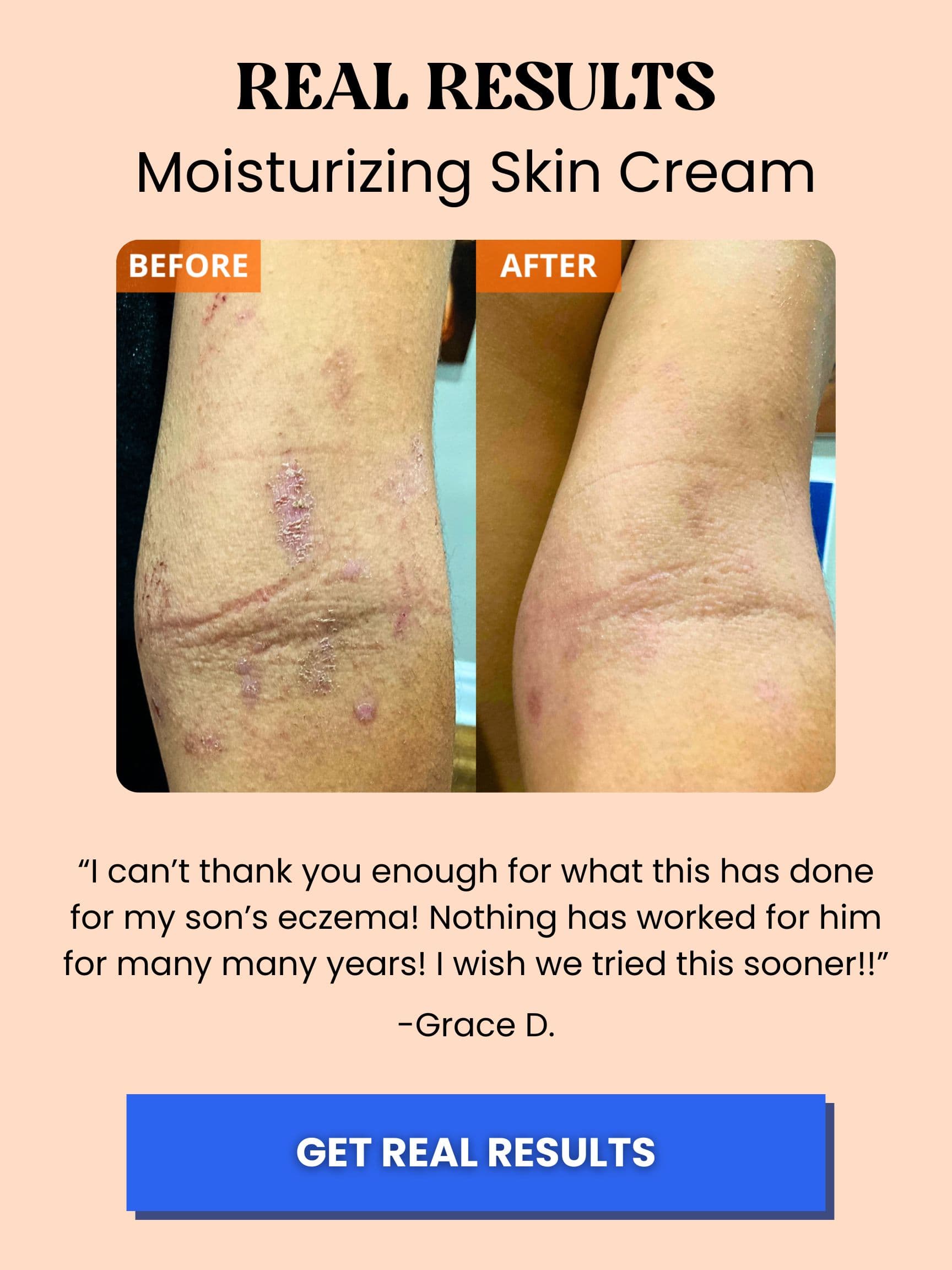 yu-be moisturizing skin cream for eczema and psoriasis