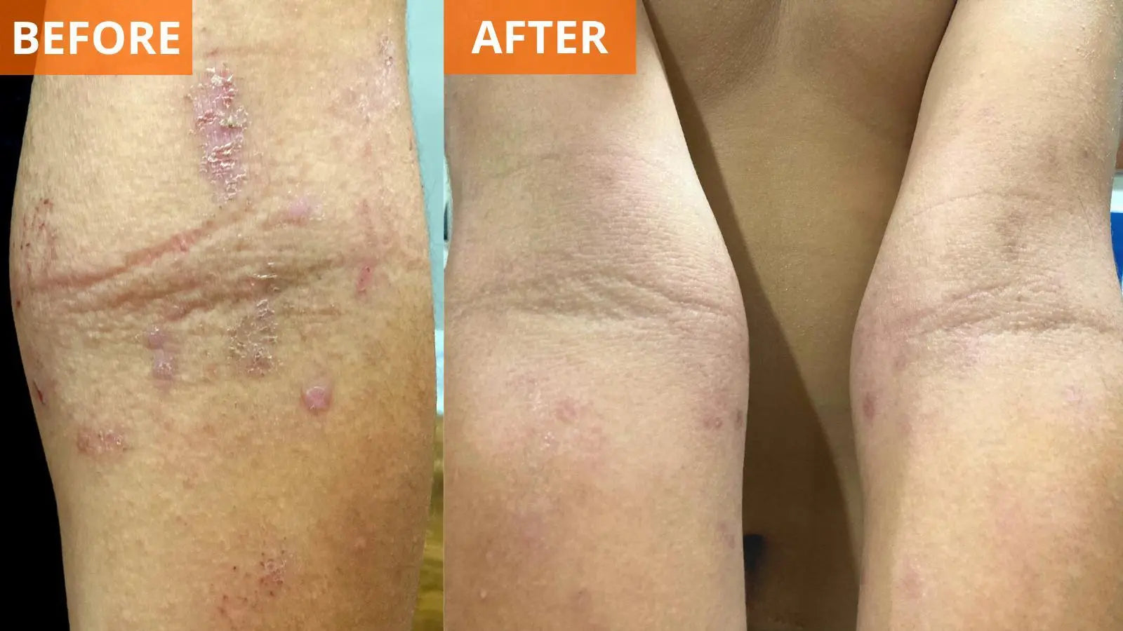 Moisturizing Body Lotion - Yu-Be - Brings immediate, visible results for those afflicted with eczema symptoms of dry, irritated, and itchy skin